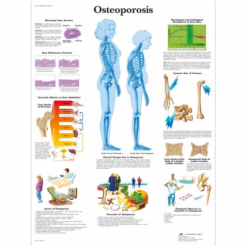 Osteoporosis Chart, 1001472 [VR1121L], Arthritis and Osteoporosis Education