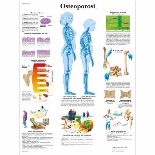 Osteoporosi, 1001967 [VR4121L], Arthritis and Osteoporosis Education