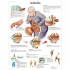 Arthritis Chart, 4006654 [VR1123UU], Skeletal System