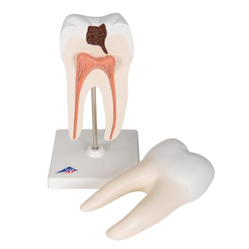 Lower Twin-Root Molar with Cavities Human Tooth Model, 2 part - 3B Smart Anatomy, 1000243 [D10/4], Replacements