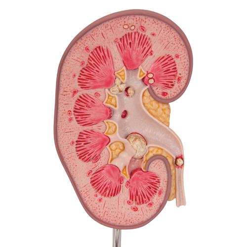 Kidney Stone Model - 3B Smart Anatomy, 1000316 [K29], Urology Models