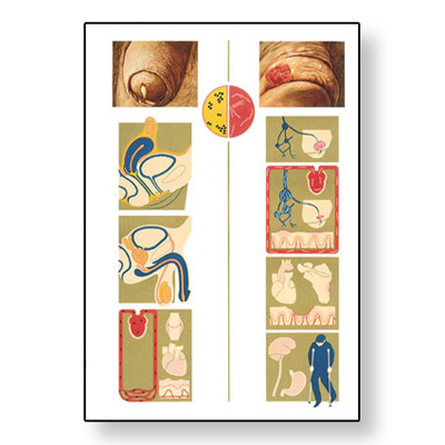 Sexually Transmitted Infections Anatomical Chart