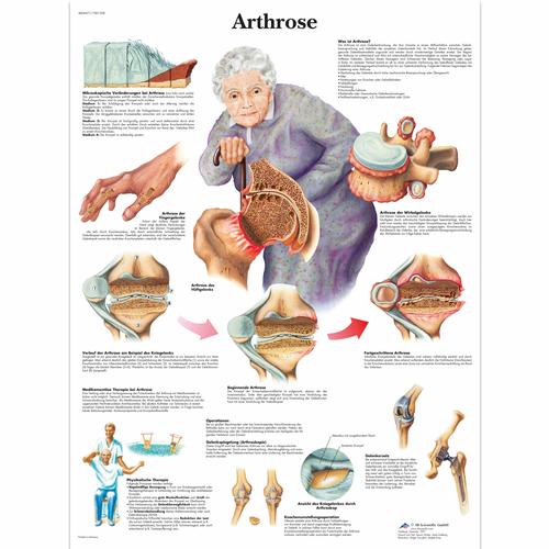 Arthrose, 4006571 [VR0123UU], Arthritis and Osteoporosis Education