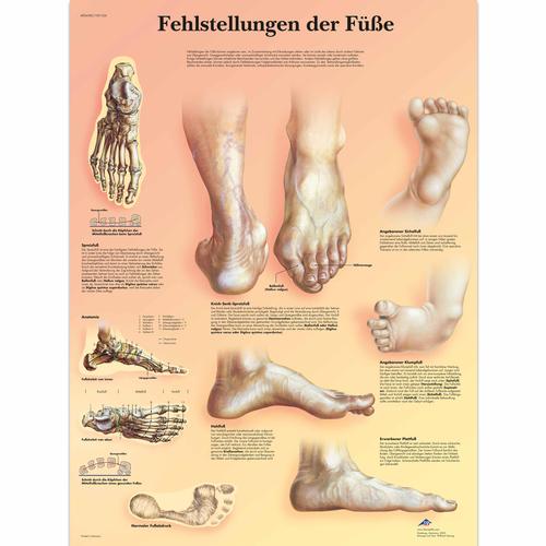 Fehlstellungen der Füße, 4006580 [VR0185UU], Skeletal System