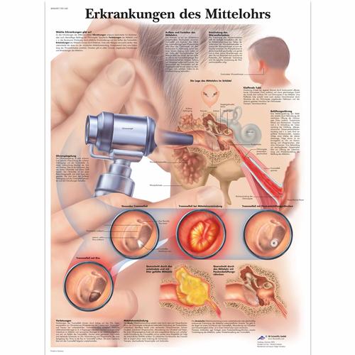 Erkrankungen des Mittelohrs, 1001340 [VR0252L], Ear, Nose and Throat (ENT)