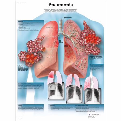 Pneumonia Chart, 1001518 [VR1326L], Parasitic, Viral or Bacterial Infection