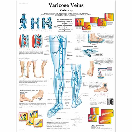 Varicose Veins Chart, 1001534 [VR1367L], Cardiovascular System