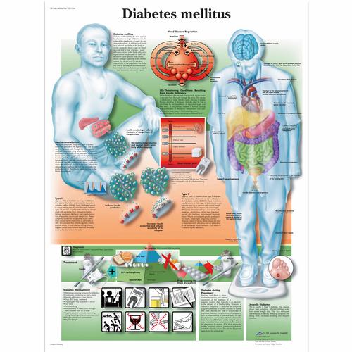 Diabetes Mellitus Chart, 1001554 [VR1441L], Diabetic Teaching Tools