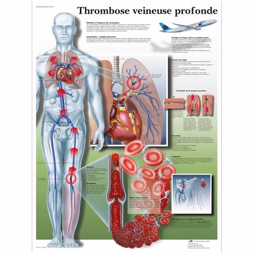 Thrombose veineuse profonde, 4006768 [VR2368UU], Cardiovascular System