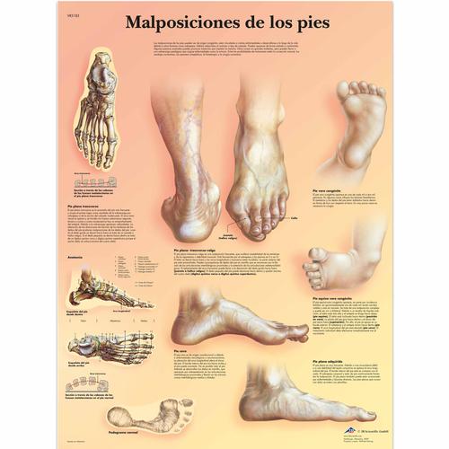 Malposiciones de los pies, 1001823 [VR3185L], Skeletal System