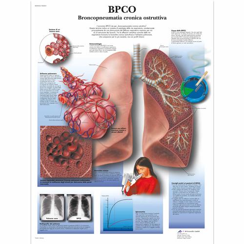 CODP Affezioni ostruttive polmonari croniche, 4006925 [VR4329UU], Tobacco Education