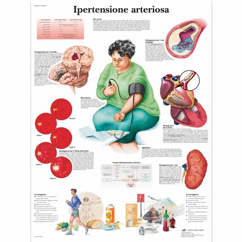 Ipertensione arteriosa, 4006931 [VR4361UU], Cardiovascular System