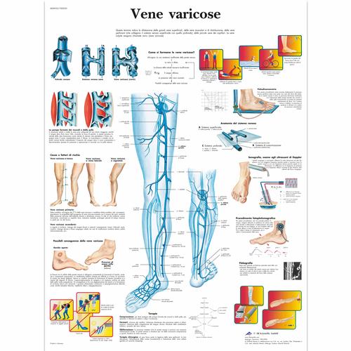 Vene varicose, 4006932 [VR4367UU], Circulatory System