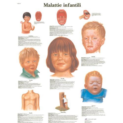 Malattie infantili, 4006974 [VR4741UU], Parasitic, Viral or Bacterial Infection