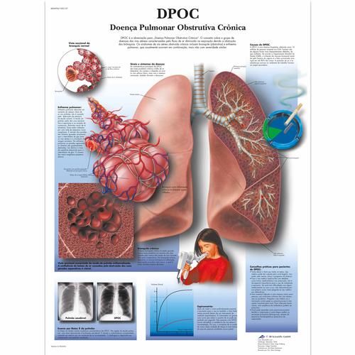 Doença pulmonar obstrutiva crônica, 50x67 cm, Versao Papel, 4006994 [VR5329UU], Tobacco Education