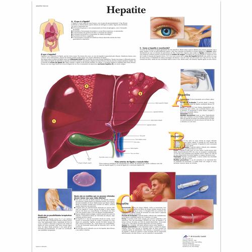 Hepatite, 50x67 cm, Versao Papel, 4006998 [VR5435UU], Metabolic System