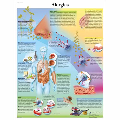 Alergias, 50x67 cm, Versao Papel, 4007011 [VR5660UU], Immune System 