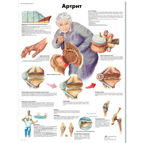 Arthritis Chart, 1002217 [VR6123L], Skeletal System