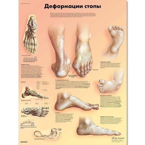 Deformities of the Feet Chart, 1002234 [VR6185L], Skeletal System