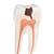 Lower Twin-Root Molar with Cavities Human Tooth Model, 2 part - 3B Smart Anatomy, 1000243 [D10/4], Replacements (Small)
