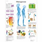 Osteoporose Chart, 1001306 [VR0121L], Arthritis and Osteoporosis Education