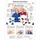 Alzheimer-Krankheit, 1001428 [VR0628L], Brain and Nervous system