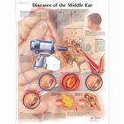 Diseases of the Middle Ear Chart, 1001506 [VR1252L], Ear, Nose and Throat (ENT)
