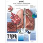 COPD Chart - Chronic Obstructive Pulmonary Disease, 1001522 [VR1329L], Respiratory System