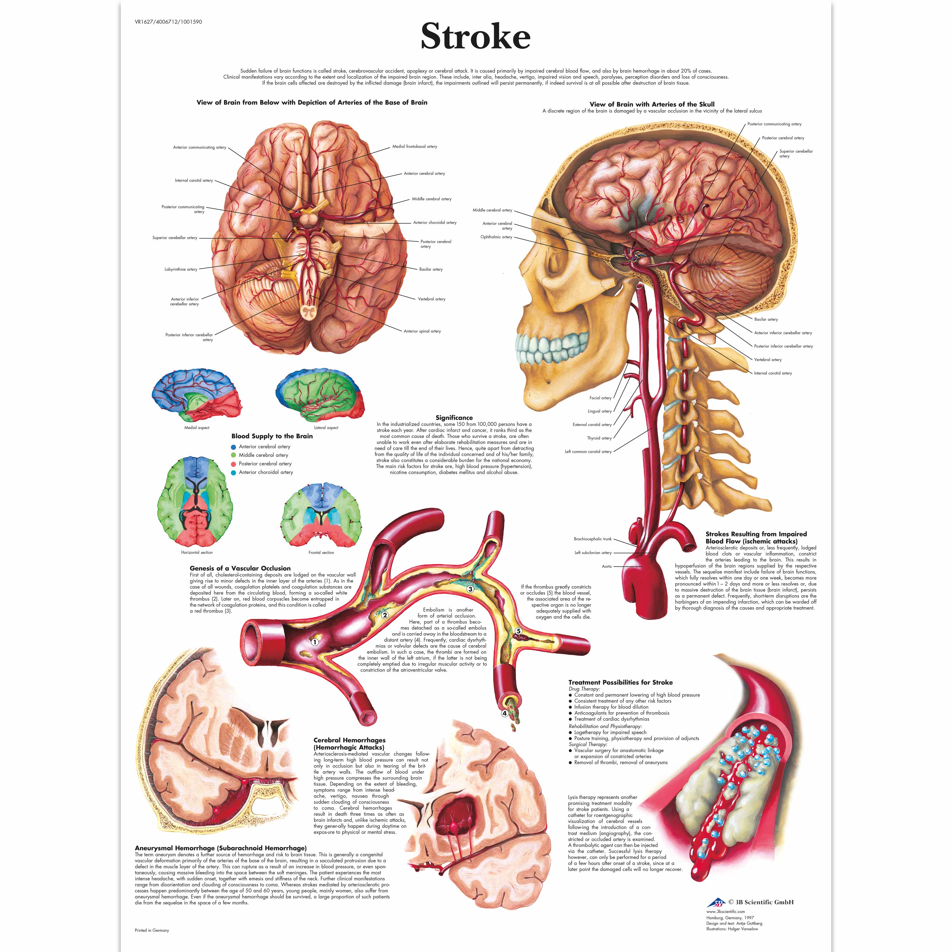 stroke and
