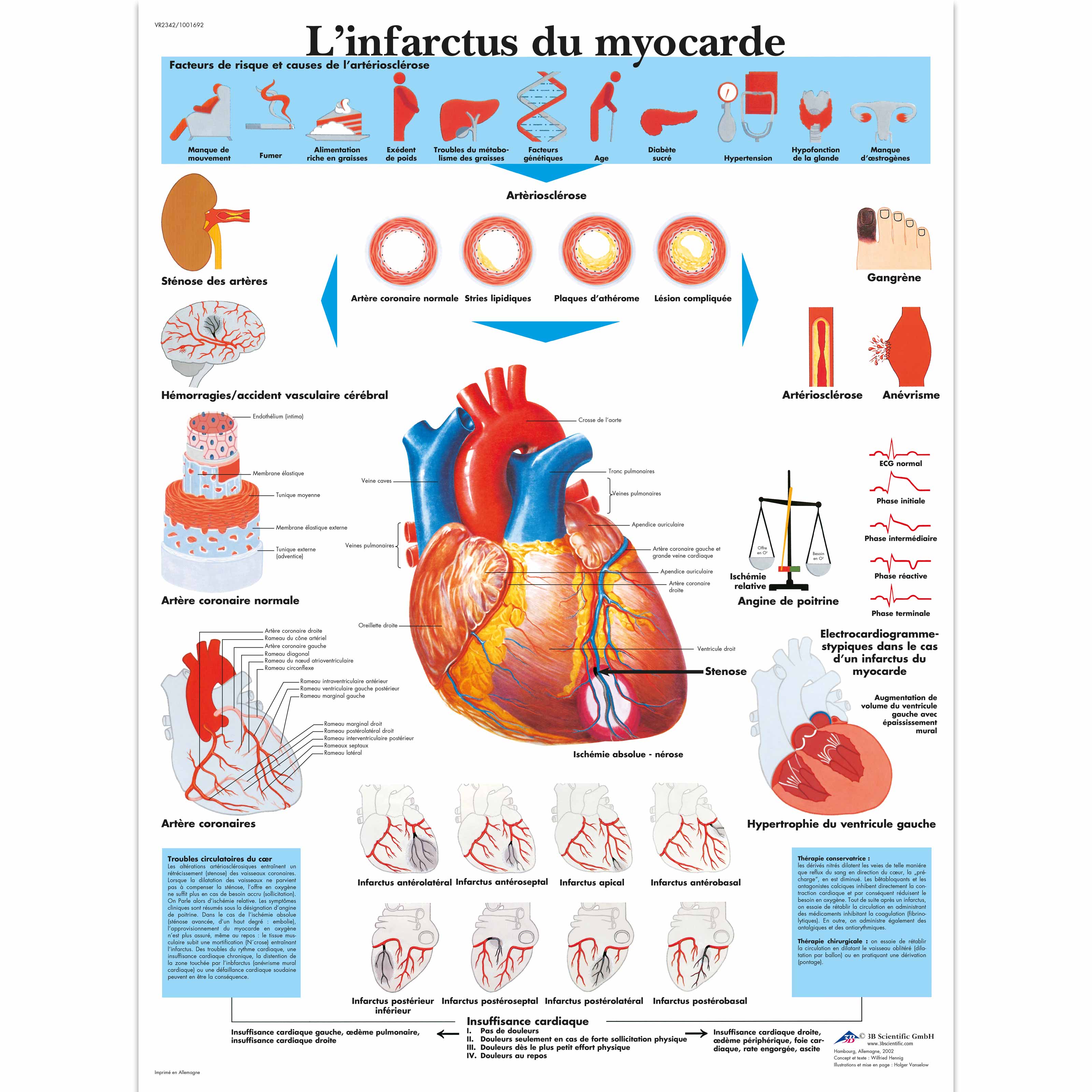 L'infarctus du myocarde - 1001692 - 3B Scientific - VR2342L - Heart ...