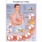 Esofagitis por reflujo, 4006880 [VR3711UU], El sistema digestivo
