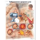 Diseases of the Middle Ear Chart, 1002247 [VR6252L], Ear, Nose and Throat (ENT)