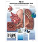 COPD Chart - Chronic Obstructive Pulmonary Disease, 1002262 [VR6329L], Respiratory System